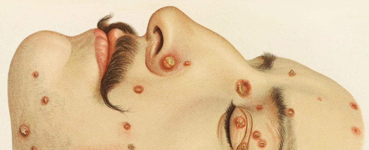 Värillinen, tarkka piirroskuva miehen kasvoista, joissa on useita punaisia, tulehtuneen näköisiä paukamia. Useimmat paukamista ovat silmien ja suun alueella.
